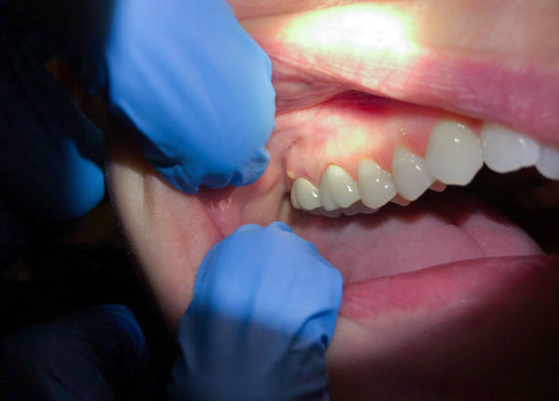 Best Emergency Wisdom Teeth Removal in Emporia, VA