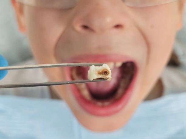 Best Emergency Root Canal Treatment in Emporia, VA