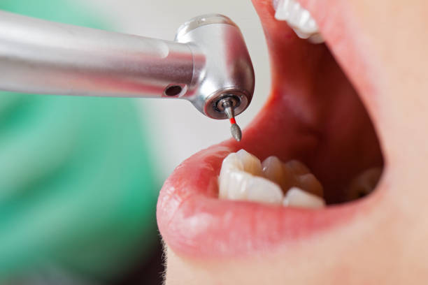 Best Emergency Root Canal Treatment in Emporia, VA